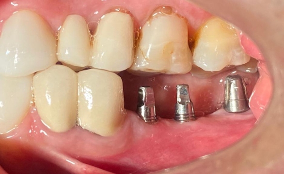 tratamiento de implantes dentales Madrid Sur antes