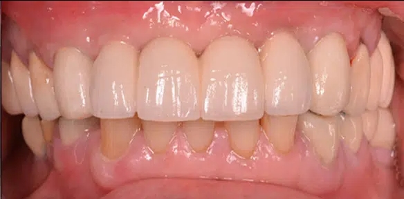 tratamiento de implantes dentales Madrid Sur después