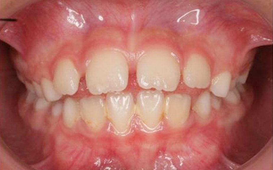 antes ortodoncia invisible invisalign madrid sur