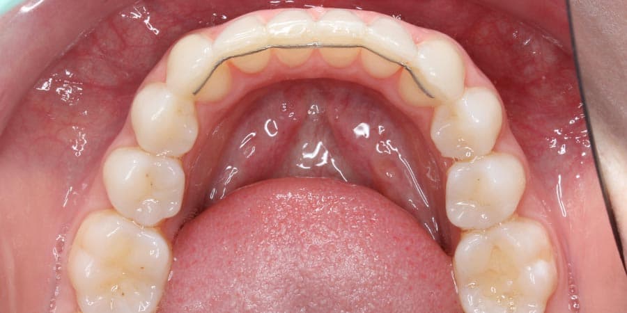 Retenedores fijos de ortodoncia en clínica dental Madrid Sur en Vallecas